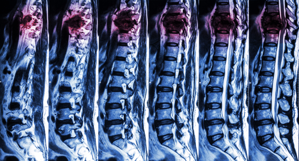 Do You Have a Spinal Cord Injury? Alleviate the Pain For Good!