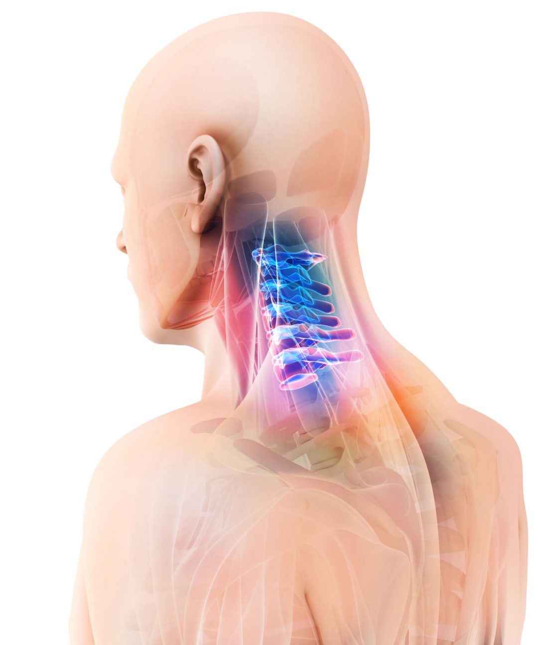 chronic-neck-pain-cell-bionics-spine-pro